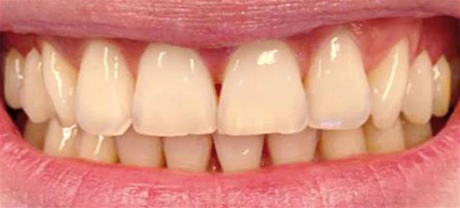 Sorriso prima dello sbiancamento: denti ingialliti